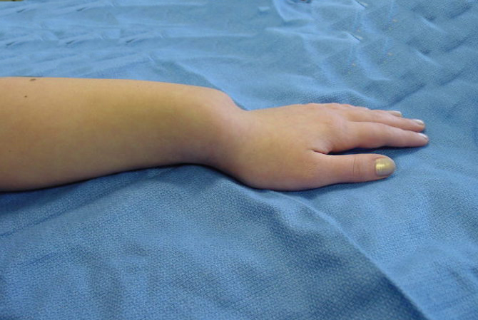 Madelung's deformity left upper extremity