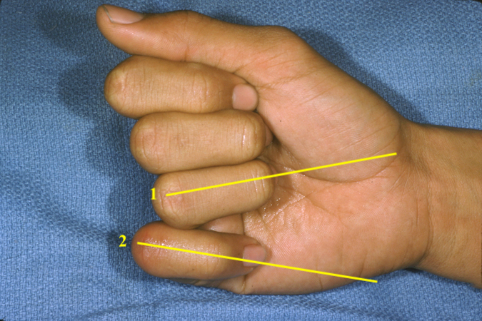 Malrotation of a fifth metacarpal fracture can be difficult to judge on X-ray and should always be checked clinically. 1 - normal axis of the flexed finger aligning with the tuberosity of the scaphoid.  2 - Axis of a malrotated fifth metacarpal neck fracture.