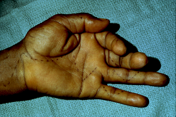 Male with long standing RA complaining of poor pinch and grip. He can not flex the thumb, index or long fingers.