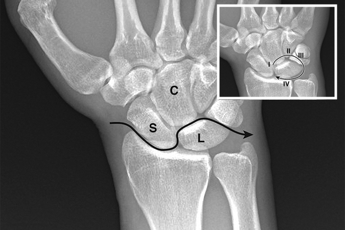 DISLOCATION, WRIST TRANSSCAPHOID PERILUNATE | Hand Surgery Resource