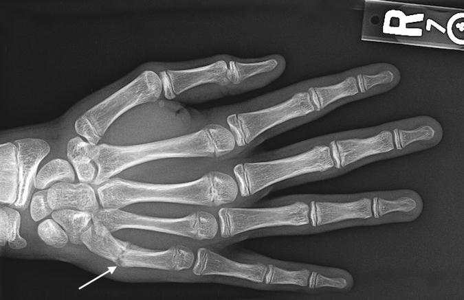 Right fifth transverse metacarpal fracture (arrow). Note  abundant callus formation.