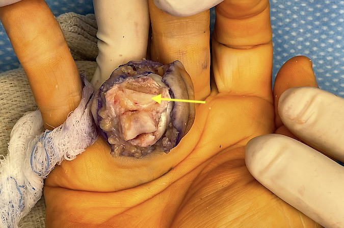 The right ring finger PIP joint has been exposed through a volar incision, the flexor sheath opened, the flexor tendons displaced, and the collateral ligaments released.  The finger is now in the “shotgun” position.  Note the arrow showing the intact dorsal cartilage of the middle phalanx. The volar cartilage is missing after removal of the fracture fragments. 