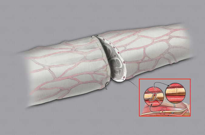 Epineural repair of lacerated digital nerve.  Insert shows microsurgical  lab exercise for practicing epineural repair in a turkey  wing model.