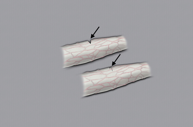 Small digital nerve partial nerve laceration treated with a single epineural micro-suture.