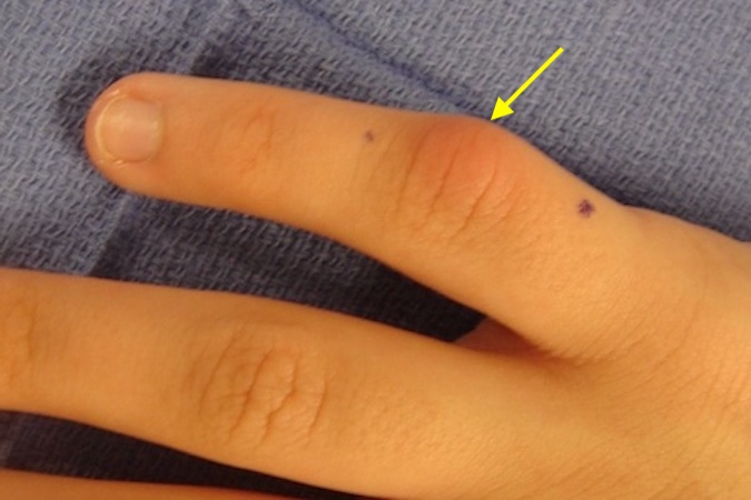 Osteochondroma originating from right little finger proximal phalanx neck (arrow)