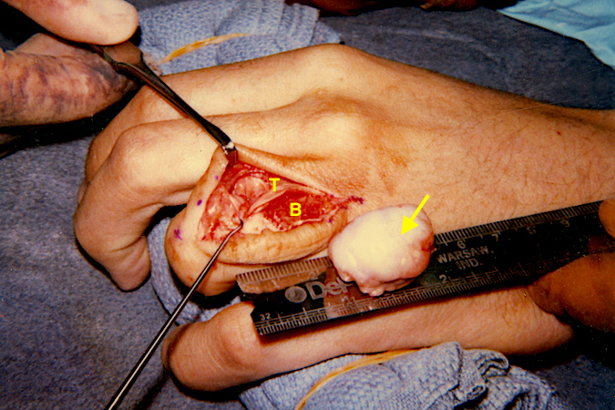 Osteochondroma originating from left ring finger proximal phalanx has been removed (arrow). The tendon (T) will be repaired over the base (B).