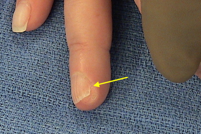 Osteochondroma (Turret Type) originating from right distal phalanx