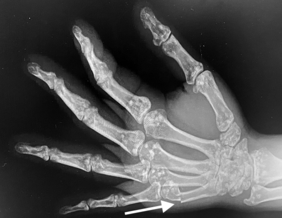 Osteopoikilosis right hand oblique X-ray with a Boxer's fracture