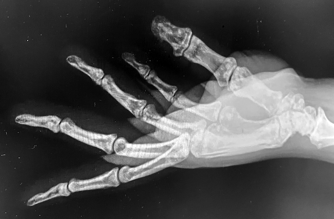 Osteopoikilosis right hand lateral X-ray with a Boxer's fracture