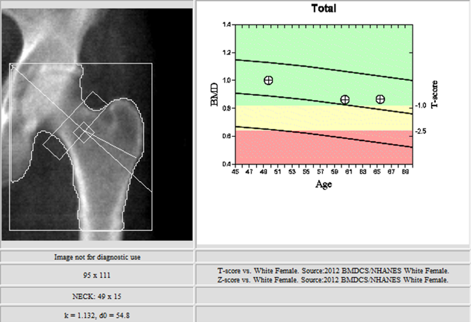 DXA Scan within the range of normal