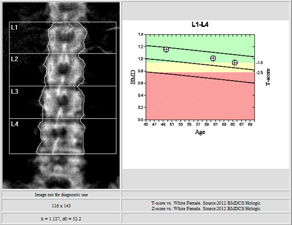 DXA Scan within the range of normal. Bone mineral density is usually calculated from the lumbar spine and femoral neck as demonstrated.