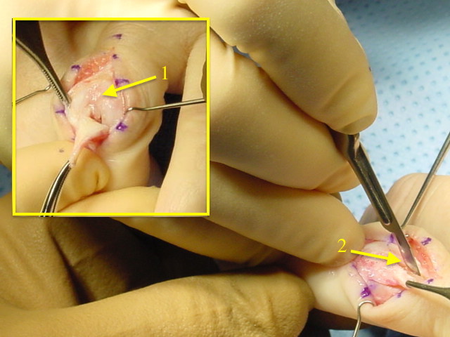 PIP joint exposed for pyrocarbon arthroplasty (1). Note extensors left attached to dorsal P2; Periosteum and capsule being removed (2) from neck of P1.