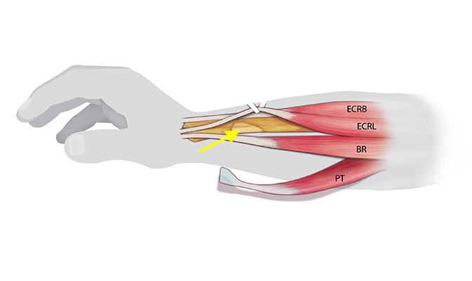 Pronator Teres has been release from the radius (arrow) and is ready to transfer to the ECRB