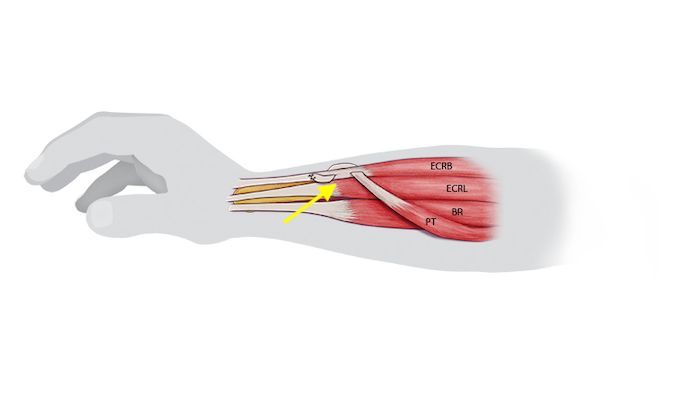 Pronator Teres (PT) has been sutured to the ECRB using a Pulvertaft weave. Some surgeons attach PT to both ECRL&B.