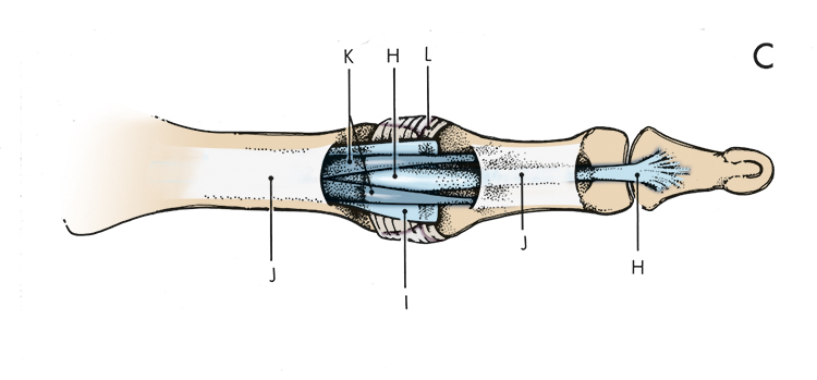 H. Flexor digitorum profundus; I. Volar plate; J. A-2 & A-4 pulley; K. Flexor digitorum superficialis; L. Transverse retinaculum.  During a volar plate injury which can cause a swan neck deformity, the volar plate (I) detaches from the base of the middle phalanx.