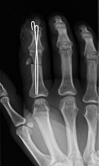 Closed reduction and percutaneous pinning of transverse comminuted closed M1/3 D1/3 proximal phalanx fracture