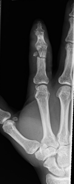 Transverse comminuted closed M1/3 D1/3 proximal phalanx fracture