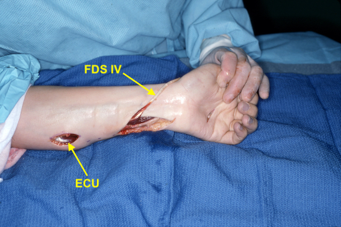 FDS IV has been release at the level of the A-1 pulley, pulled out of the carpal tunnel and will be transferred to EPL in this patient without a PL.  Note EDC will be transferred to the combined EDC tendons.