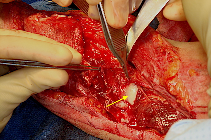 Lateral elbow after debridement with damaged distal and proximal radial nerve ends in the forceps. Unsalvageable radial nerve extended proximally and distally with a large segmental loss of nerve. Capitellum (arrow).