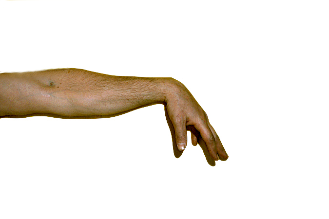 Classic wrist drop secondary to radial nerve palsy. Note lack of thumb, finger and wrist extension.