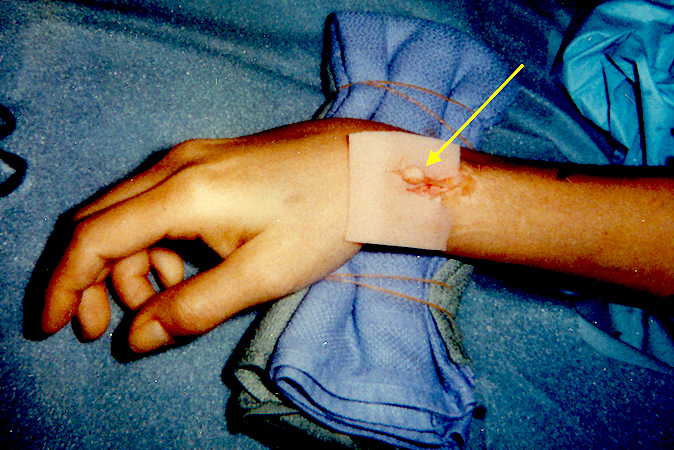 Dorsal radial sensory neuroma from untreated laceration at level of the radial styloid prior to resection and transposition.