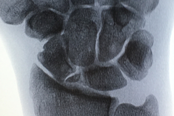 SNAC Wrist with early arthritic radioscaphoid joint and proximal pole scaphoid nonunion with no stress applied to the wrist joint.