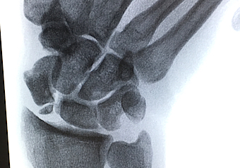 SNAC Wrist with early arthritic radioscaphoid joint and proximal pole scaphoid nonunion with ulnar deviating STRESS applied to the wrist joint.