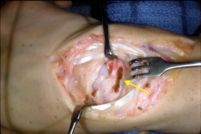 Scaphoid non-union (arrow) with opening for a dorsal Russe bone graft.