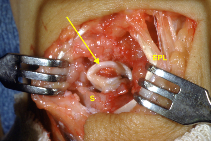 Failed scaphoid non-union treated with excision of the proximal pole and insertion of a facial arthroplasty (arrow) using palmaris longus tendon.