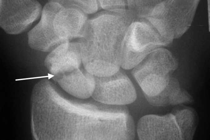 Right scaphoid non-union (arrow).  Injury occurred 5 months earlier. Note absorption and sclerosis at the fracture line.