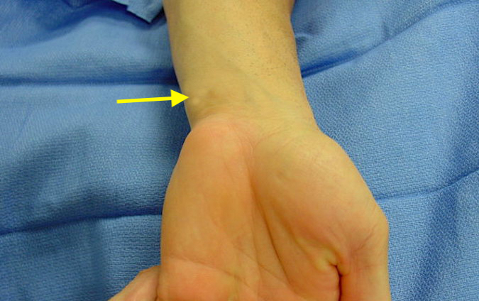 Synovial Chondromatosis of right DRUJ with palpable deep mass (arrow) , tenderness, and crepitus.