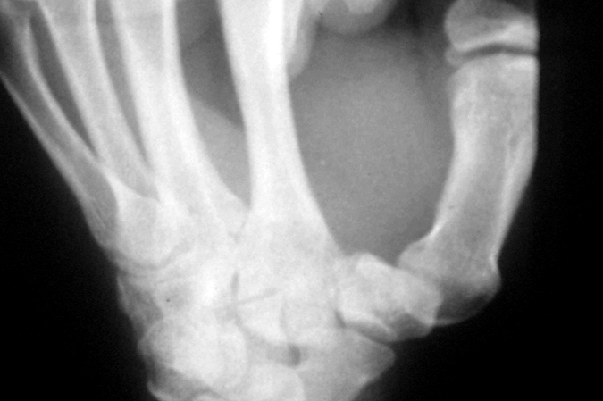 Thumb CMC Dislocation without fracture treated with closed reduction . After cast removed at 6 weeks severe CMC subluxation.  Reduction, pinning and cast may have prevent symptomatic subluxation.