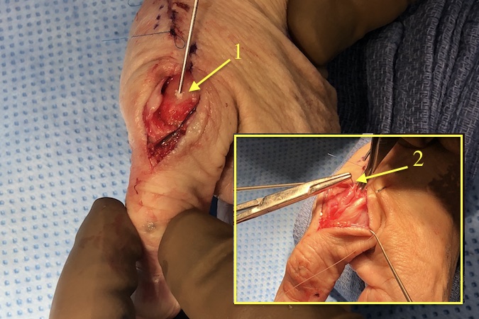 Final MP joint compression secured by K-wire(s). MP capsule and EPL/EPB extensor interval being sutured. (2)