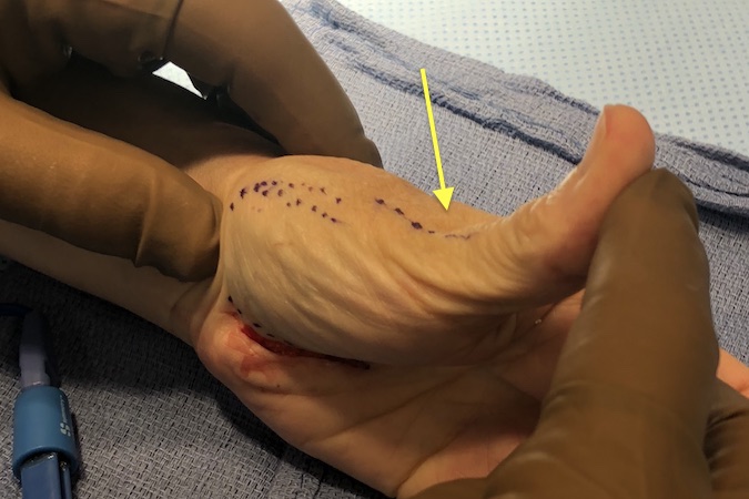 Thumb hypertension must be controlled at the time of Thumb CMC arthroplasty.  An excellent control method is thumb MP joint fusion which is also an excellent surgical treatment for MP joint OA.