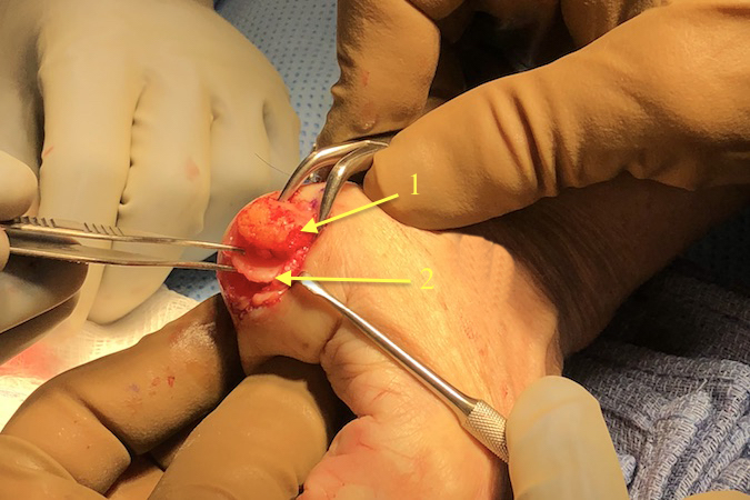 Metacarpal head shaped to fit into the base (cone) of the proximal phalanx (1); Cartilage cap has been remove after outlining the osteo-cartilage interval with a small K-wire and completing the removal with a small osteotome. (2) 