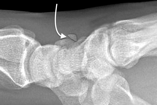 Triquetrum "Avulsion" Fracture (curved arrow)