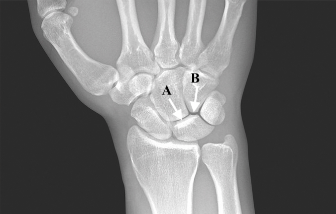 HAMATE ARTHROSIS (PROXIMAL POLE) | Hand Surgery Resource