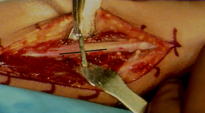 First cut in the ulna has been made 90% through the ulna.  Extra saw blade held in this first partial cut to act as a guide for second free hand transverse osteotomy cut.  Line etched along longitudinal axis to guide normal rotational alignment after osteotomies completed and ORIF completed.