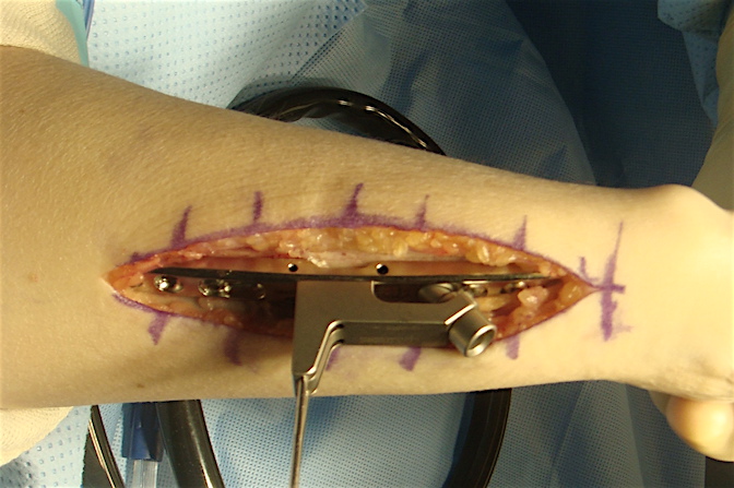 Plate attached proximally with 3 cortical screws and distally with one screw distally in the slotted hole (arrow).  Oblique screw guide held in place with short and long K-wires. 