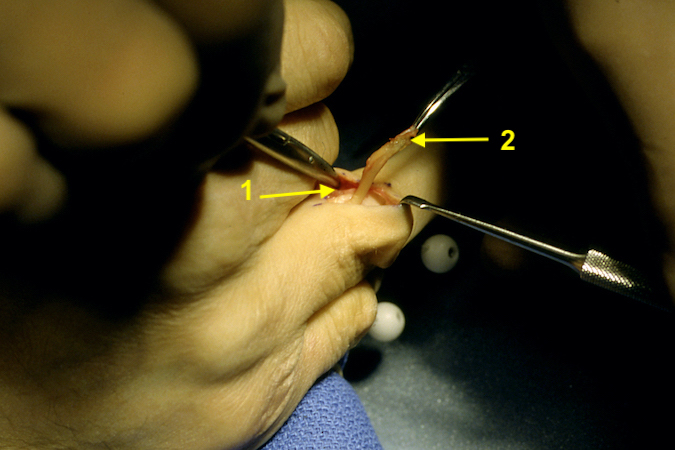  Stiles-Bunnell tendon transfer using FDS (2) which will be woven into and sutured to the radial lateral band (1).