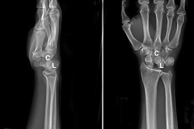 Right volar perilunate dislocation X-ray. Note capitate(C) and lunate(L).