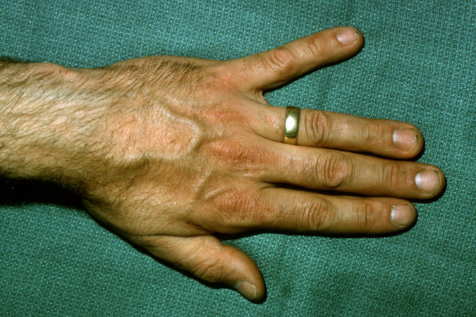 Wartenberg's Sign | Hand Surgery Resource