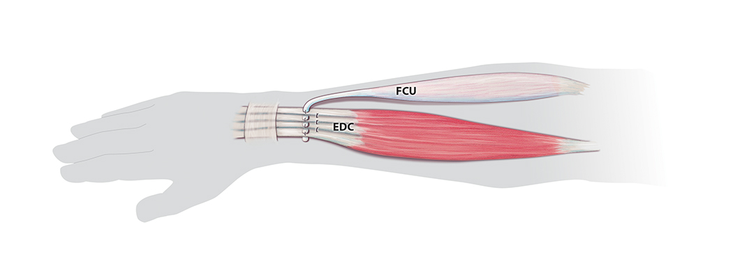 First EDC tendons have been sutured together with fingers evenly extended at the MP joints. Secondly the FCU has been sutured to the combined EDC tendons.